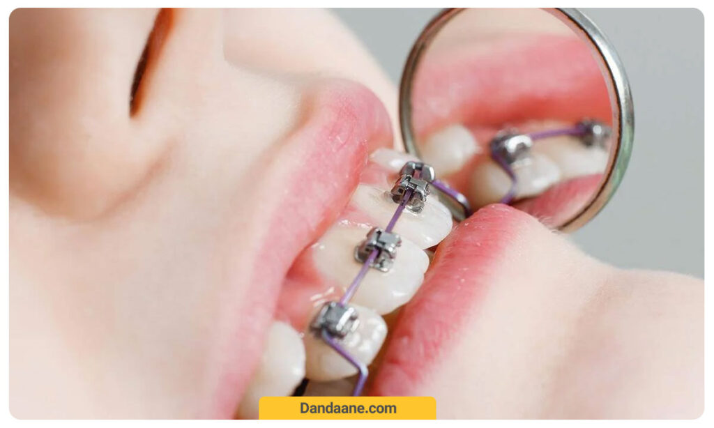 ارتودنسی ثابت برای زنان