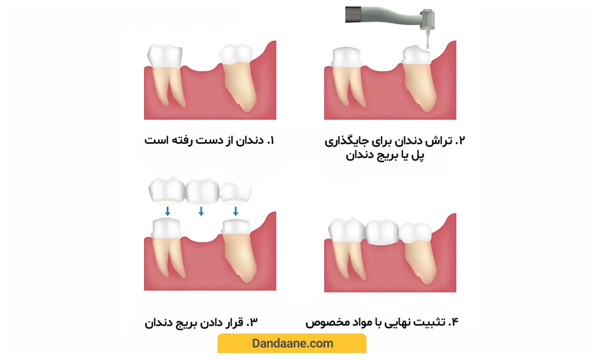 عکس از مراحل بریج دندان
