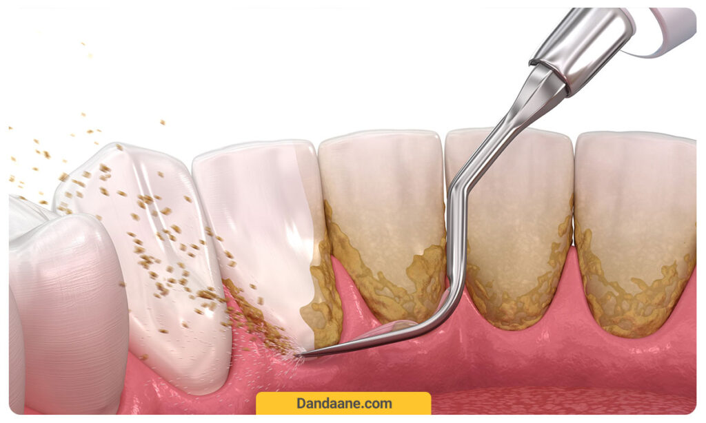 جرمگیری دندان