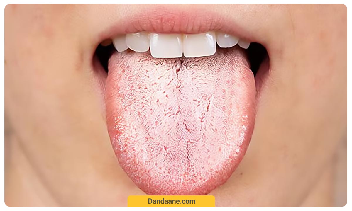 پوشش سفید یا زرد روی زبان