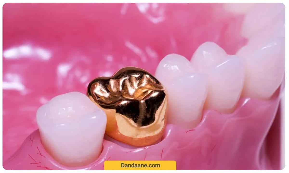 ماندگاری تاج های طلا