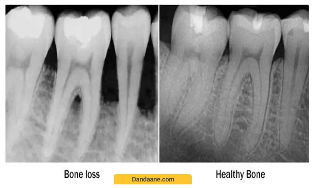 تحلیل استخوان 