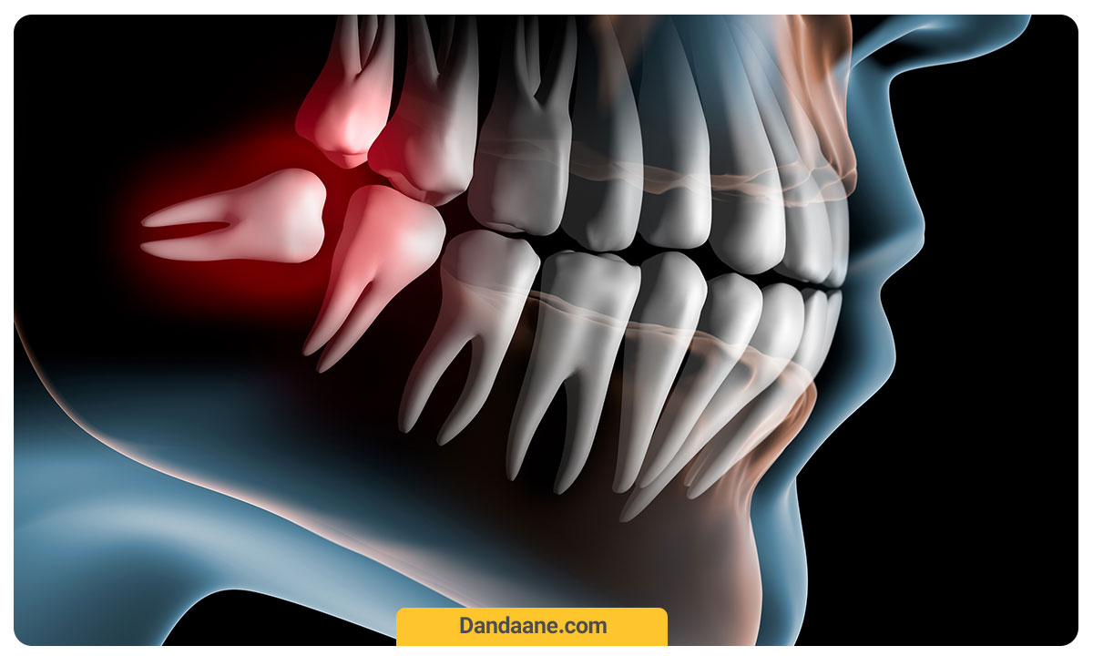 عوارض دندان عقل نیمه نهفته