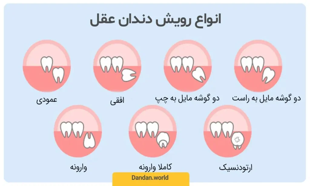 انواع مدل های رشد دندان عقل 