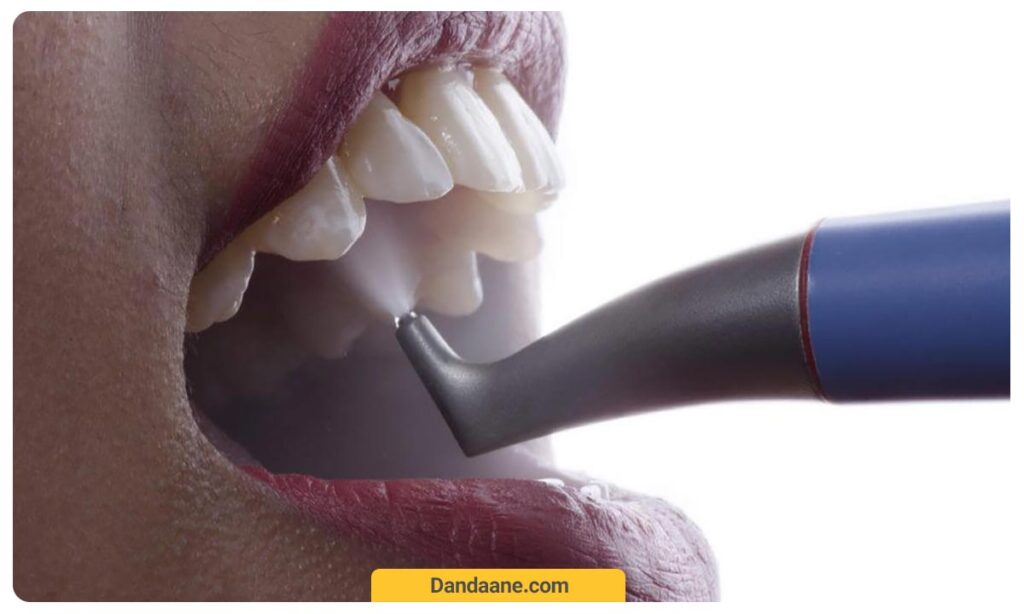 جرمگیری دندان با دستگاه ایرفلو