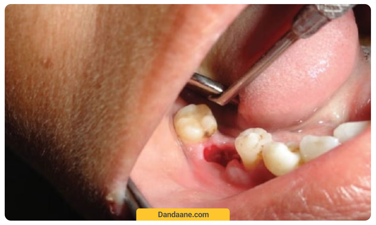 حفره خشک دندان