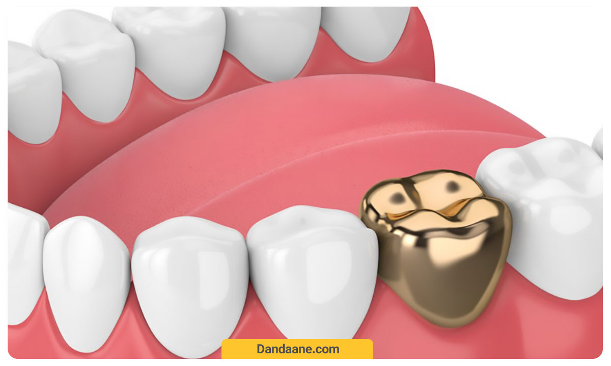 روکش دندان طلا