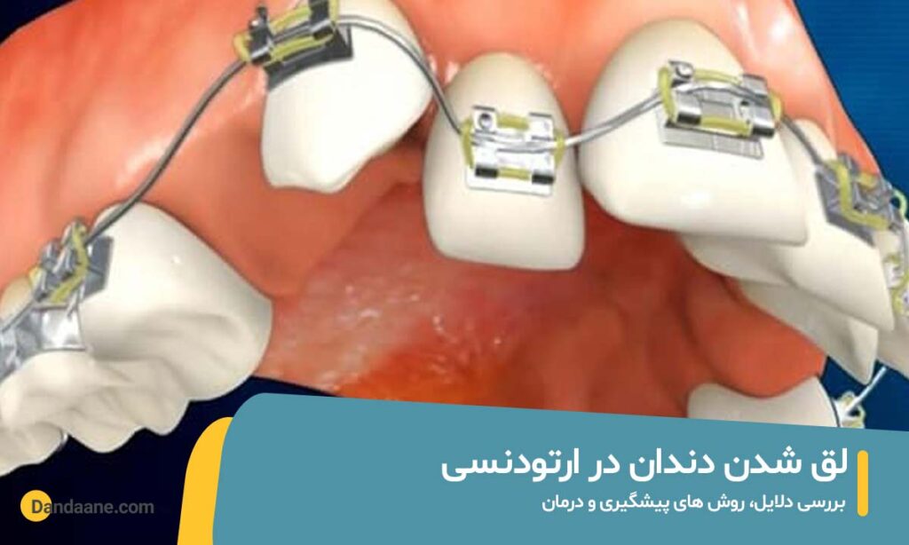 لق شدن دندان در ارتودنسی