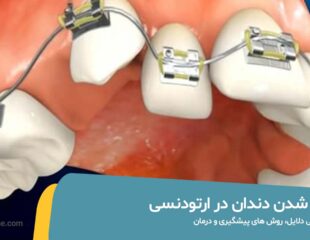 لق شدن دندان در ارتودنسی
