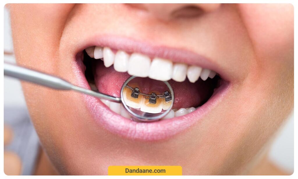 ارتودنسی پشت دندانی کودکان