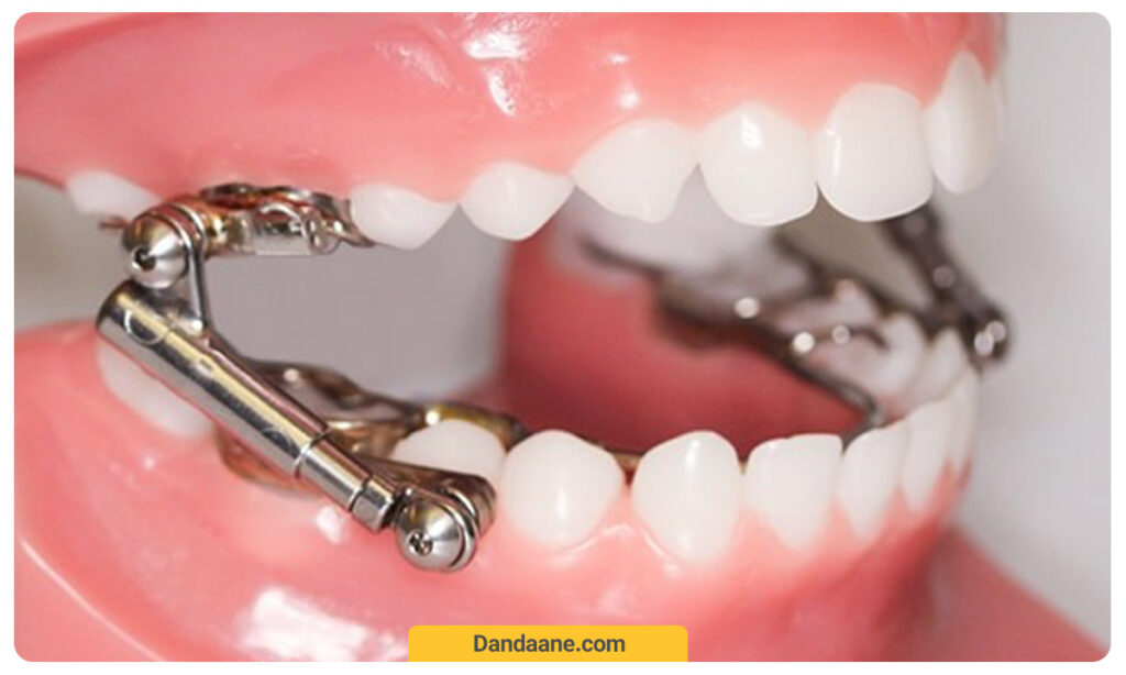 عکس ارتودنسی فانکشنال