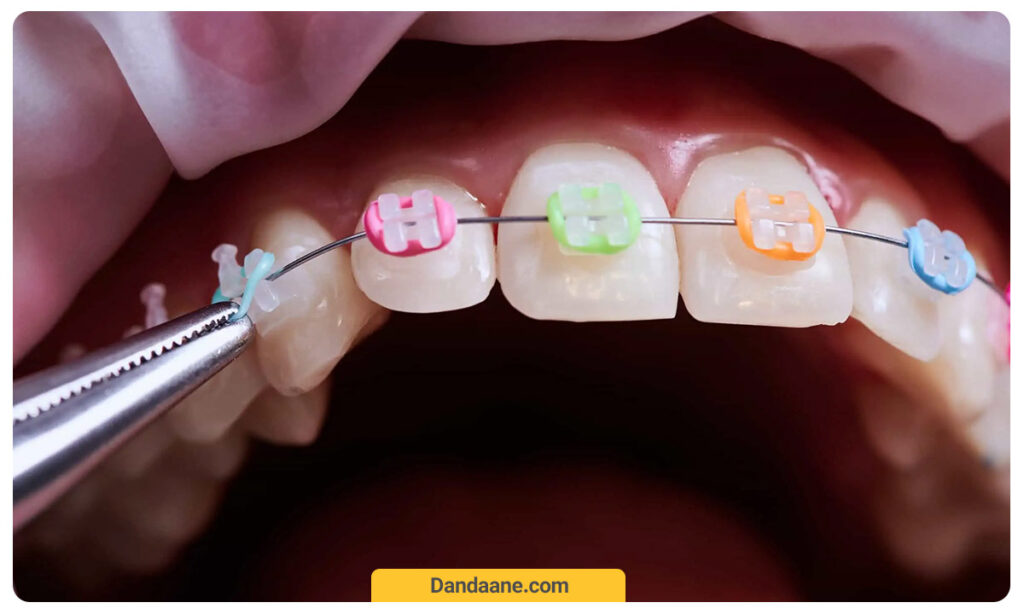 عکس بریس های رنگی ارتودنسی ثابت فلزی