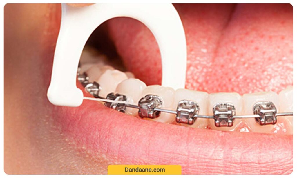 مسواک زدن دندان ارتودنسی شده