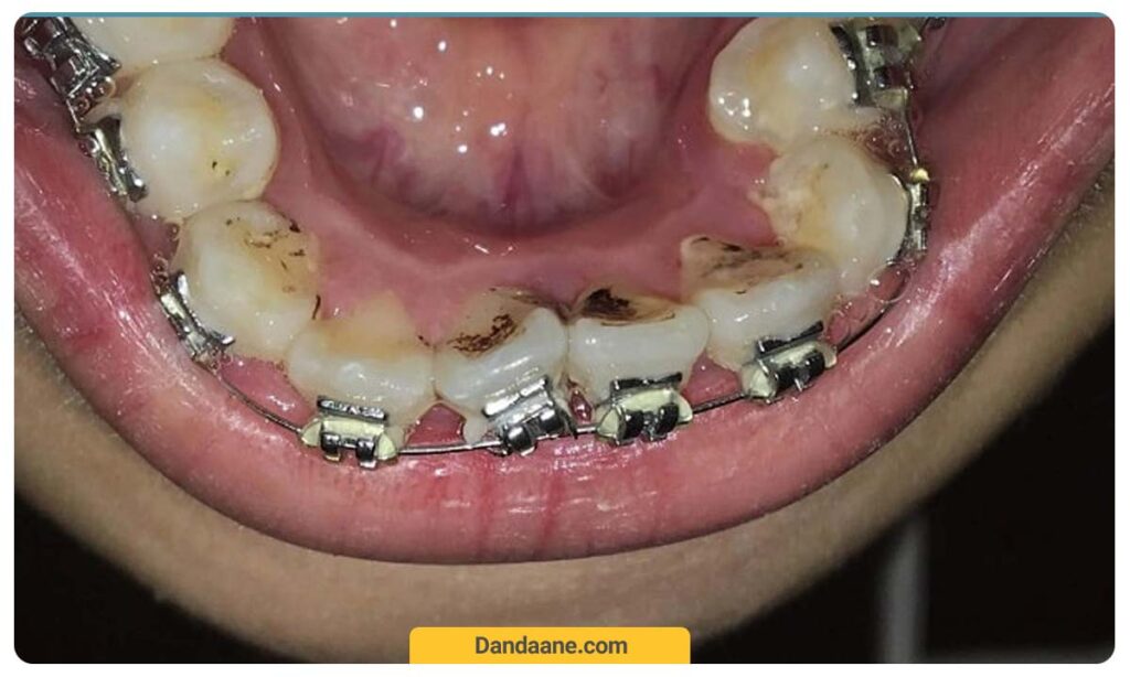 پوسیدگی دندان در طول ارتودنسی