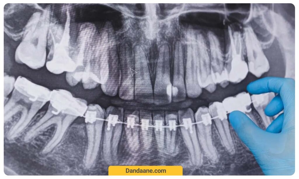 پوسیدگی روی عکس دندان