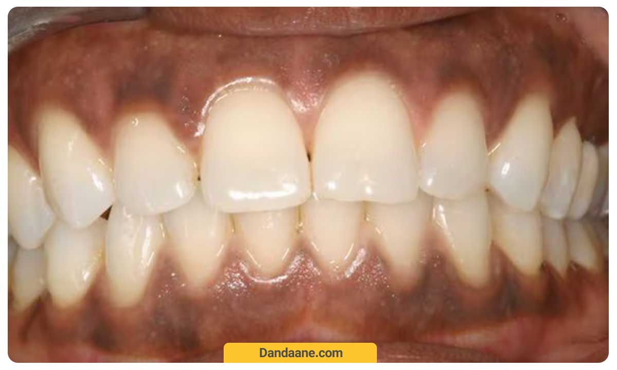 سیاه شدن لثه