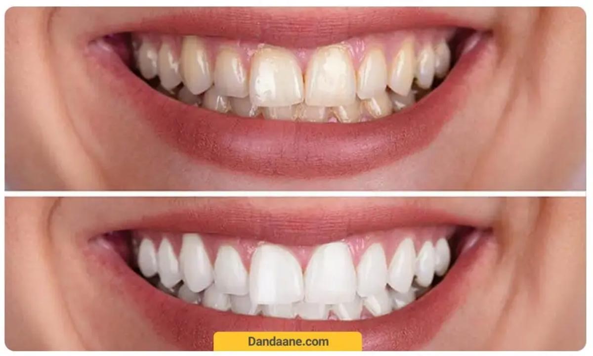 تفاوت بلیچینگ و کامپوزیت دندان