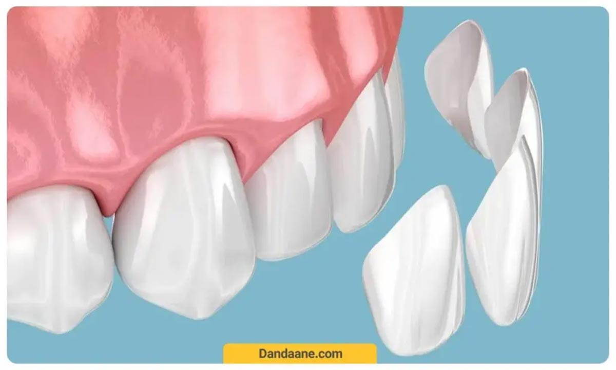 تصویر شماتیک از کامپوزیت دندان