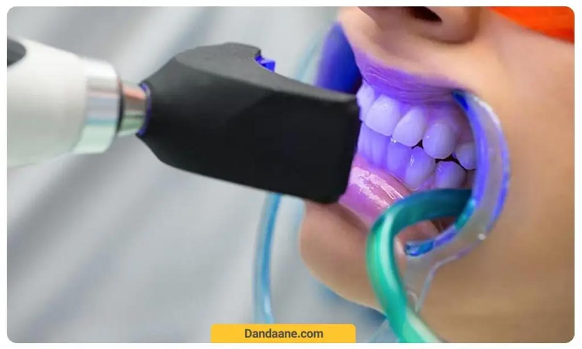 تصویری از نحوه بلیچینگ کردن دندان