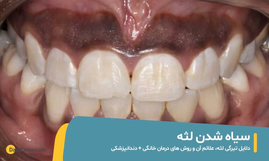 سیاه شدن لثه