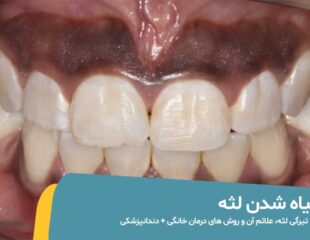 سیاه شدن لثه