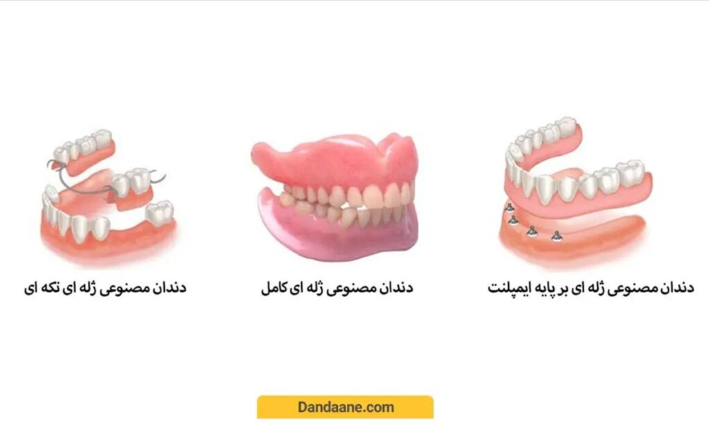 دندان مصنوعی ژله ای 