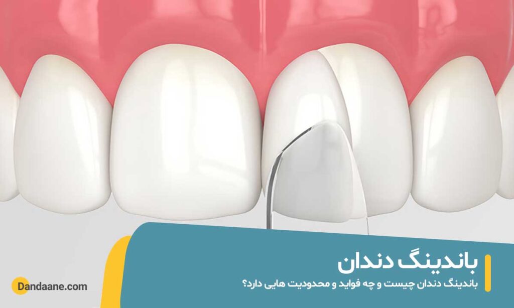 باندینگ دندان چیست