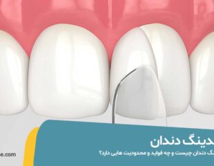باندینگ دندان چیست