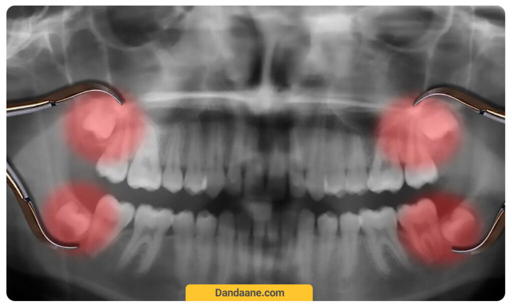 عکس‌ رادیولوژیک از دندان نهفته
