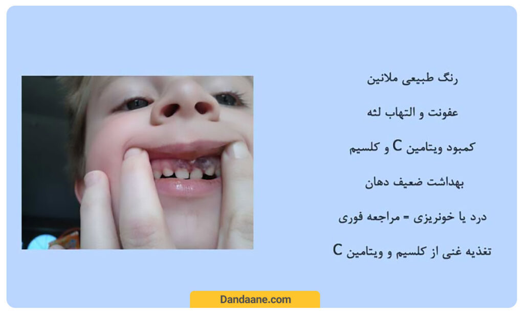 دلایل سیاه شدن لثه در کودکان