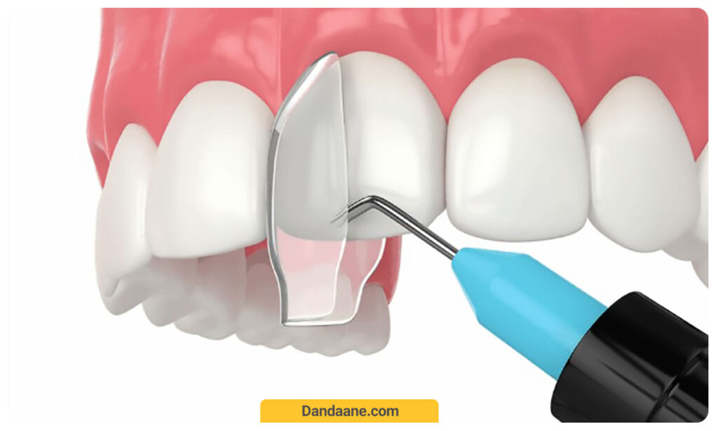 پروسه باندینگ دندان