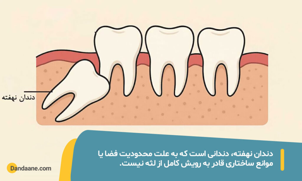 دندان نهفته چیست؟