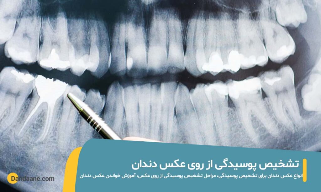 تشخیص پوسیدگی از روی عکس دندان