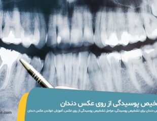 تشخیص پوسیدگی از روی عکس دندان
