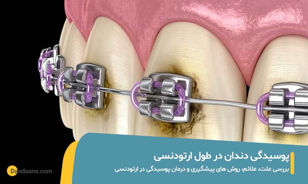 پوسیدگی دندان در ارتودنسی