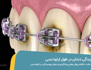 پوسیدگی دندان در ارتودنسی