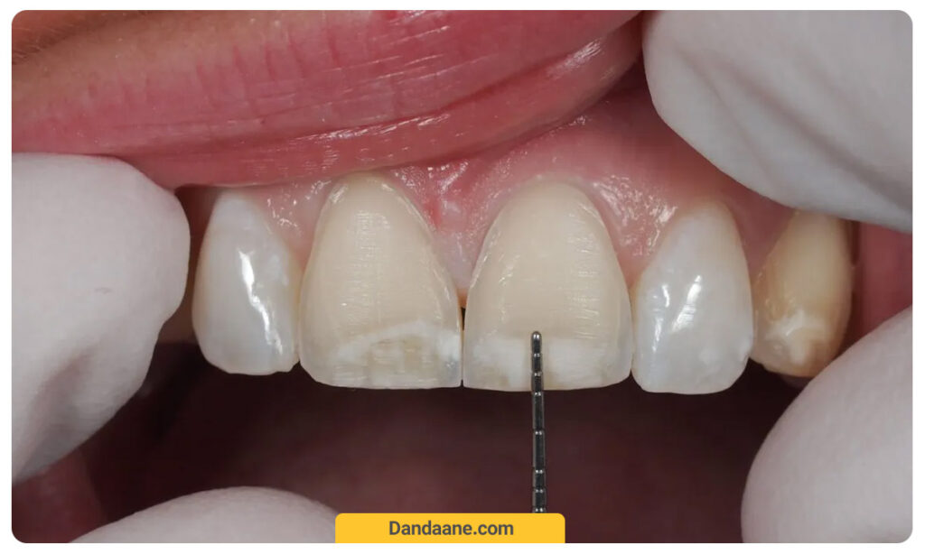 برداشتن کامپوزیت دندان