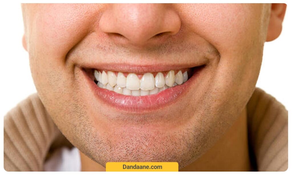 کمی غیر طبیعی بودن کامپوزیت دندان