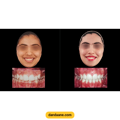 نمونه کار ارتودنسی دکتر کوثر عزیزلو