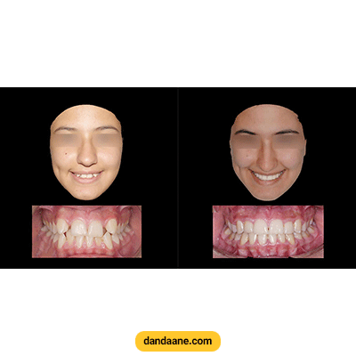 نمونه کار ارتودنسی دکتر کوثر عزیزلو شماره 1