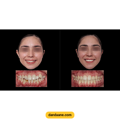 نمونه کار ارتودنسی دکتر کوثر عزیزلو شماره 2