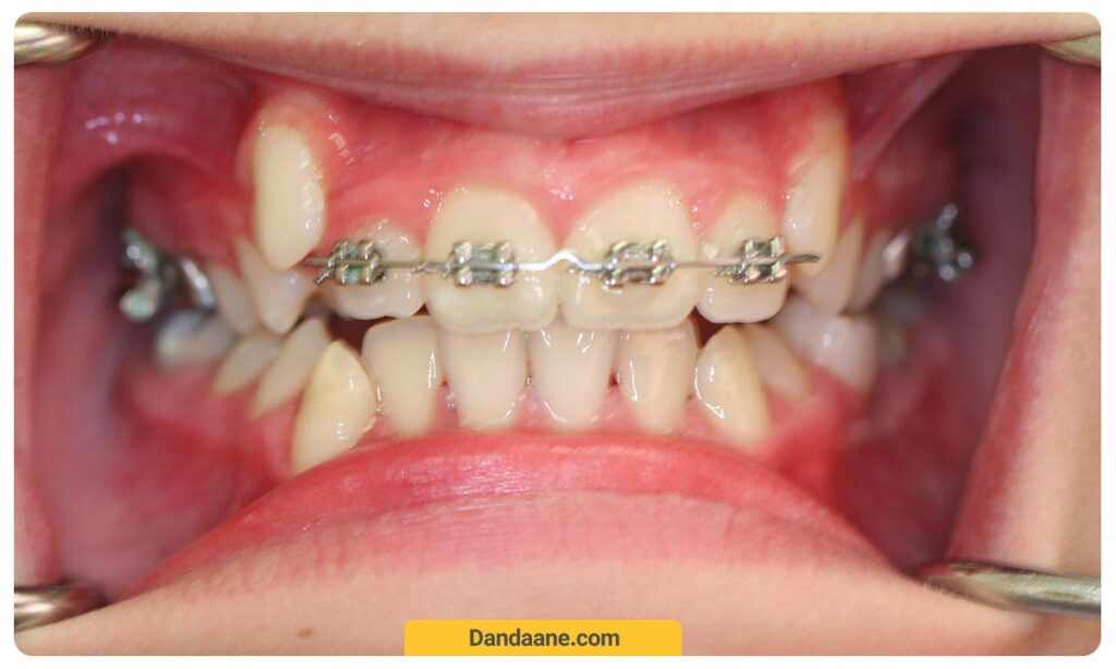 ارتودنسی دندان