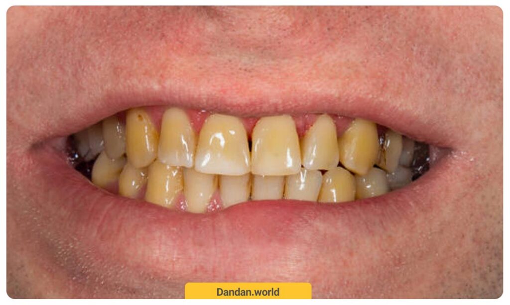 بد رنگ شدن دندان ها