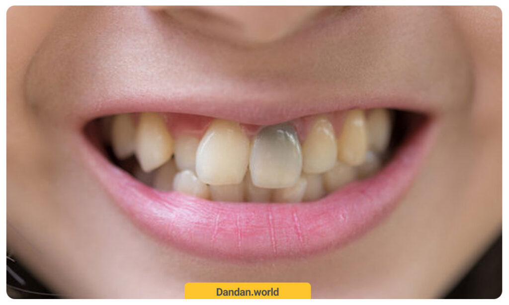 تغییر رنگ دندان به سیاه