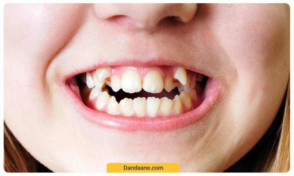 دندان اضافه در لثه بالا
