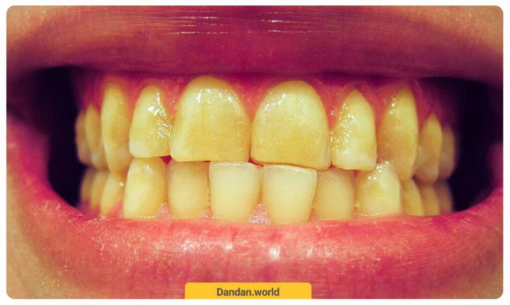 زرد شدن دندان ها