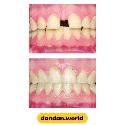 قبل و بعد نمونه کار بستن فاصله بین دندان ها با ارتودنسی دکتر فریبز جعفرپور