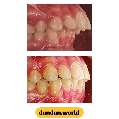 قبل و بعد نمونه کار ارتودنسی دکتر فریبرز جعفرپور