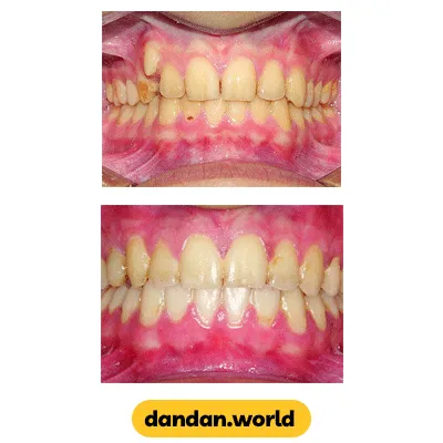 قبل و بعد نمونه کار هدایت دندان نیش نهفته به موقعیت صحیح دکتر فریبرز جعفرپور