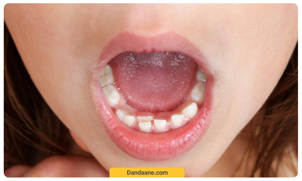 نیفتادن دندان شیری